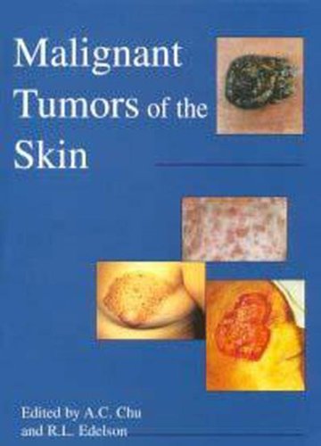 

mbbs/3-year/malignant-tumors-of-the-skin-9780340740866