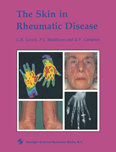 

general-books/general/the-skin-in-rheumatic-disease--9780412290008