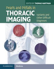 

exclusive-publishers/cambridge-university-press/pearls-and-pitfalls-in-thoracic-imaging--9780521119078