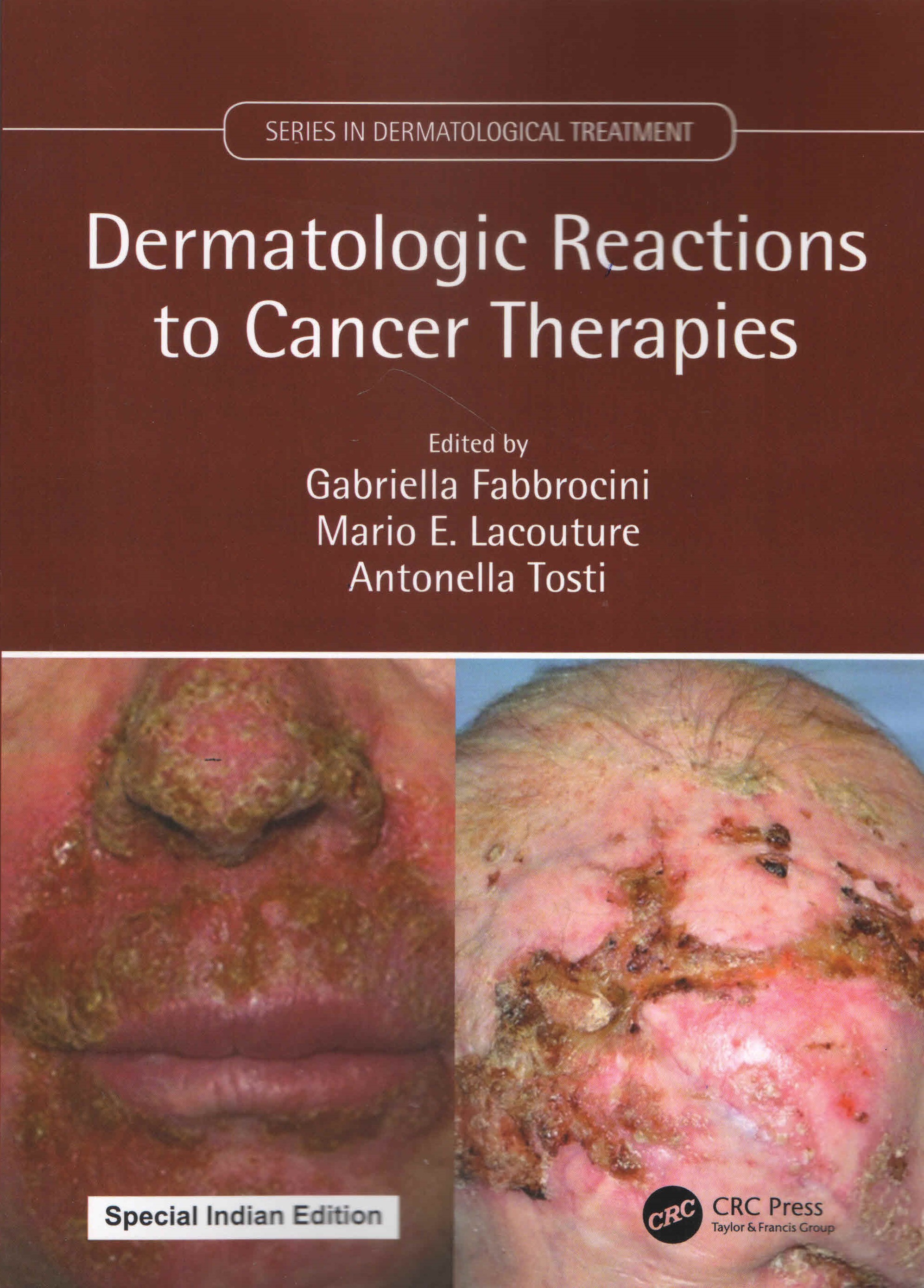 

exclusive-publishers/taylor-and-francis/dermatologic-reactions-to-cancer-therapies-9781032783536