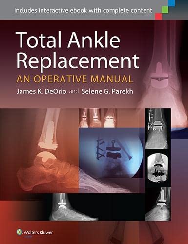 

mbbs/4-year/total-ankle-replacement-an-operative-manual-9781451185225