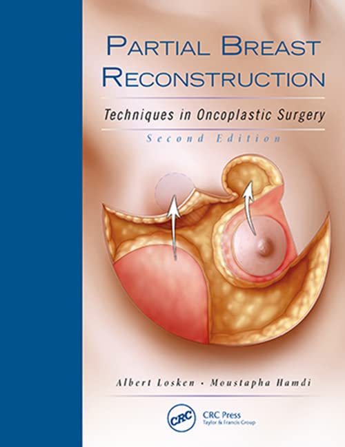

exclusive-publishers/thieme-medical-publishers/partial-breast-reconstruction-techniques-in-oncoplastic-surgery-2-e--9781626236912