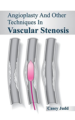 

clinical-sciences/cardiology/angioplasty-and-other-techniques-in-vascular-stenosis-9781632420480