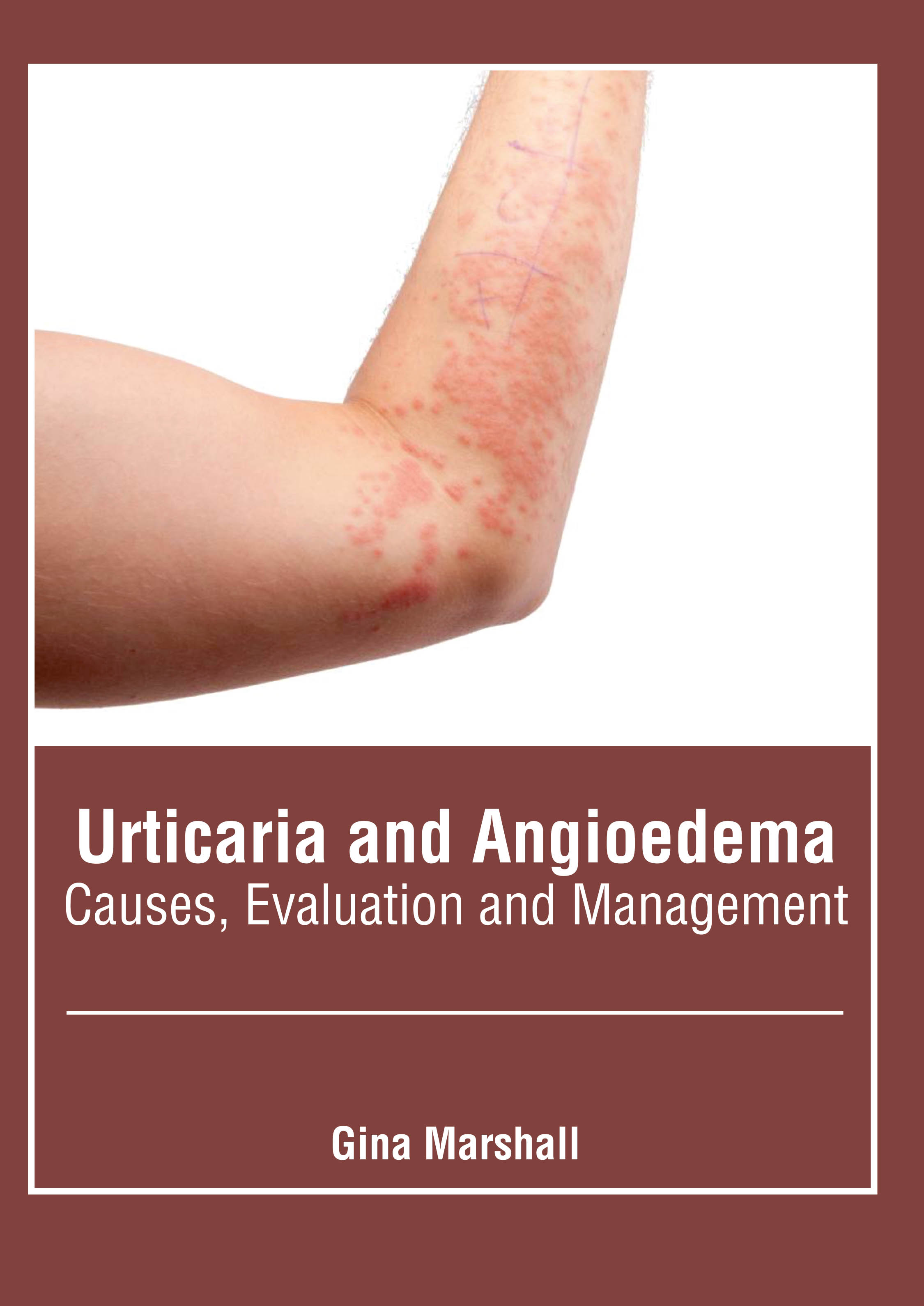 

medical-reference-books/dermatology/urticaria-and-angioedema-causes-evaluation-and-management-9781639270675