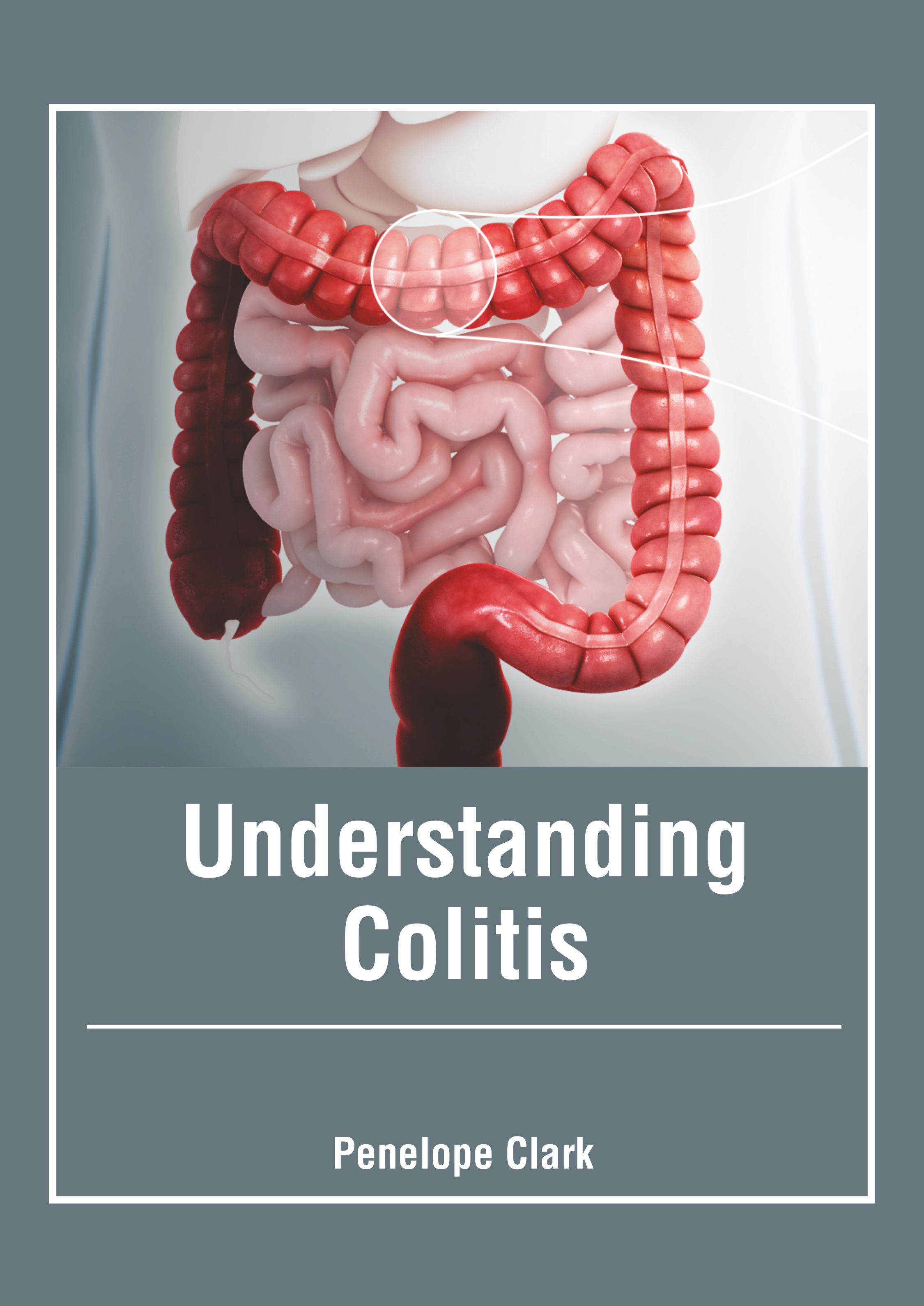 

exclusive-publishers/american-medical-publishers/understanding-colitis-9781639271467