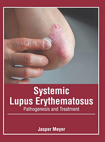 

medical-reference-books/microbiology/systemic-lupus-erythematosus-pathogenesis-and-treatment-9781639272136