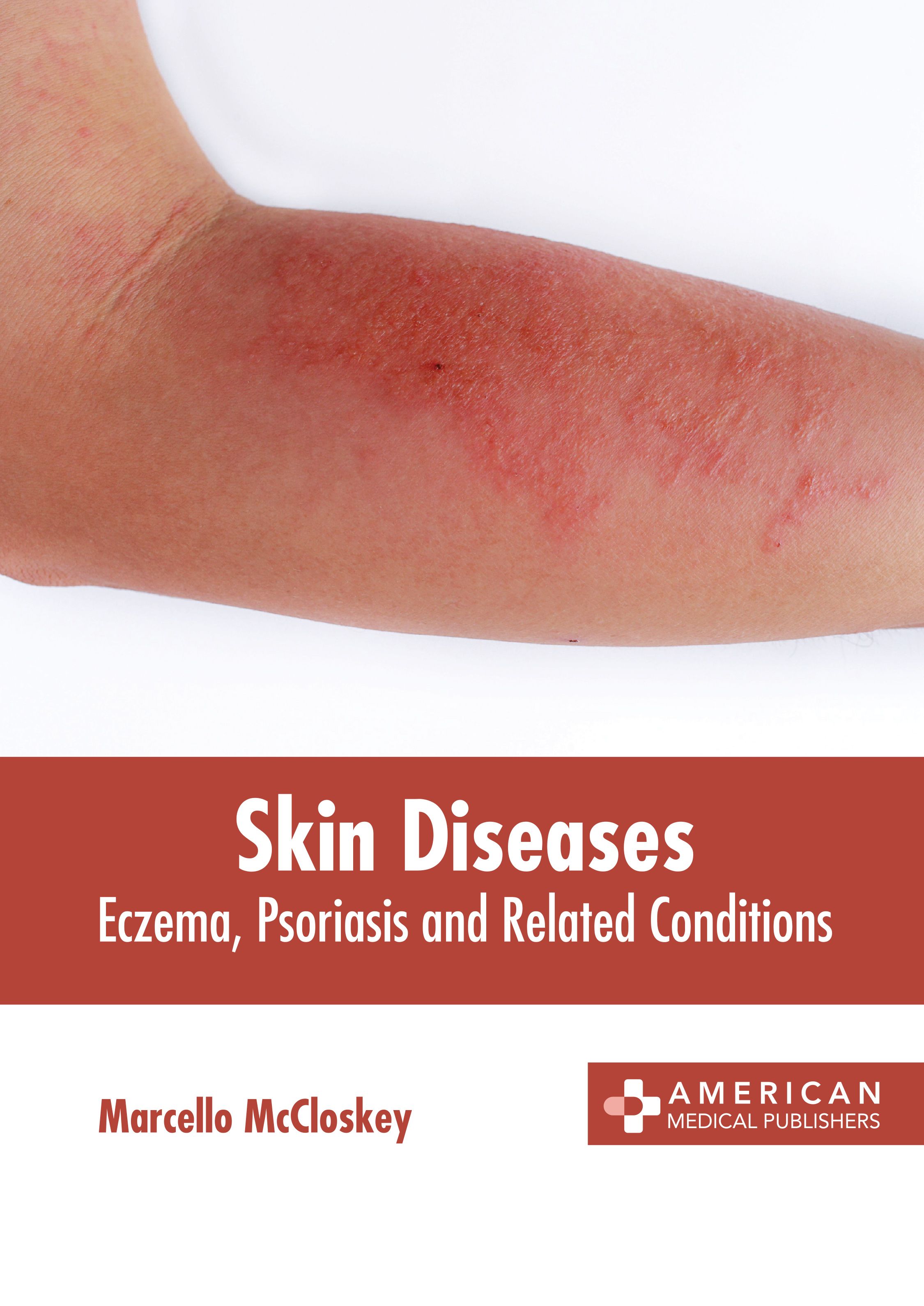 

exclusive-publishers/american-medical-publishers/skin-diseases-eczema-psoriasis-and-related-conditions-9781639278053