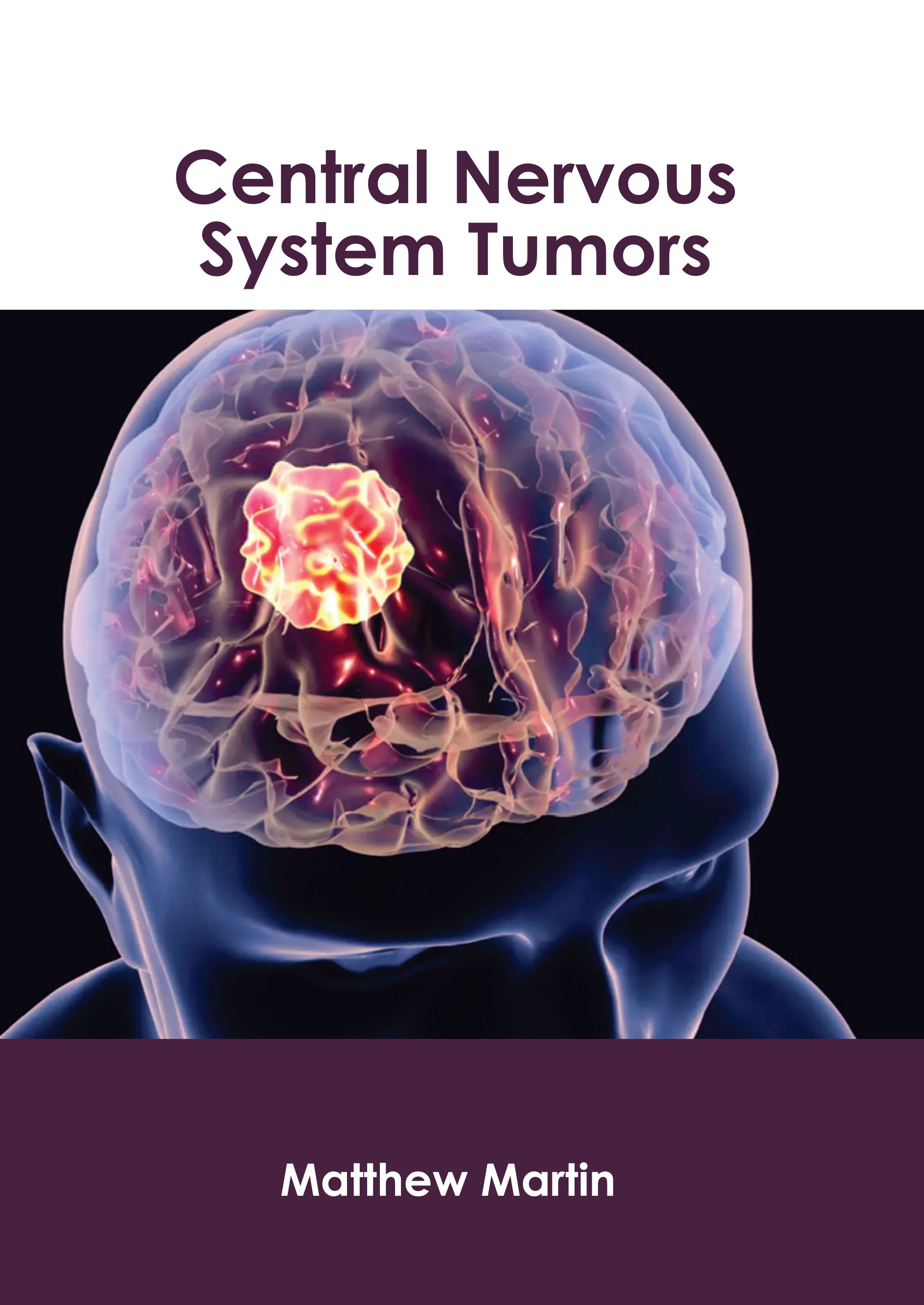 

exclusive-publishers/american-medical-publishers/central-nervous-system-tumors-9781639279722