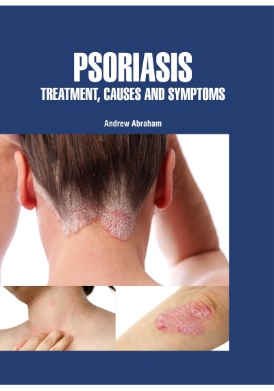 

mbbs/3-year/psoriasis-treatment-causes-and-symptoms-9781788825245