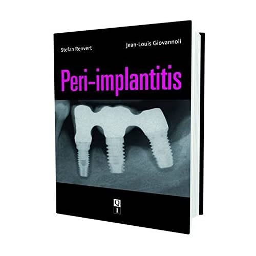 

general-books/general/peri-implantitis--9782912550989