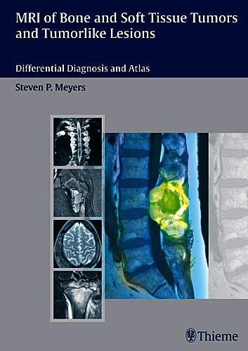 MRI OF BONE AND SOFT TISSUE TUMORS AND TUMORLIKE LESIONS: DIFFERENTIAL DIAGNOSIS AND ATLAS;