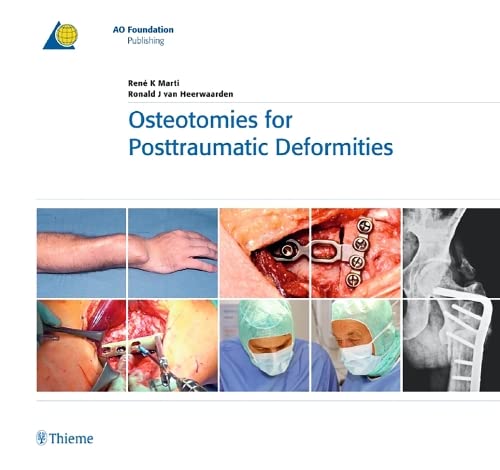 

exclusive-publishers/thieme-medical-publishers/osteotomies-for-posttraumatic-deformities-1-e--9783131486714