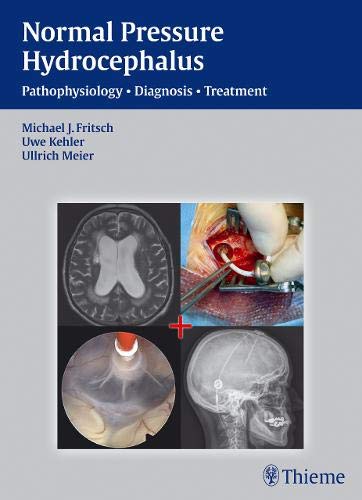 

exclusive-publishers/thieme-medical-publishers/nph---normal-pressure-hydrocephalus-pathophysiology---diagnosis---treatment--9783131646019