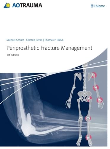 

exclusive-publishers/thieme-medical-publishers/periprosthetic-fracture-management-1-ed--9783131715111