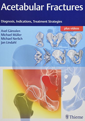 

exclusive-publishers/thieme-medical-publishers/acetabular-fractures-diagnosis-indications-treatment-strategies-1-e--9783132415607