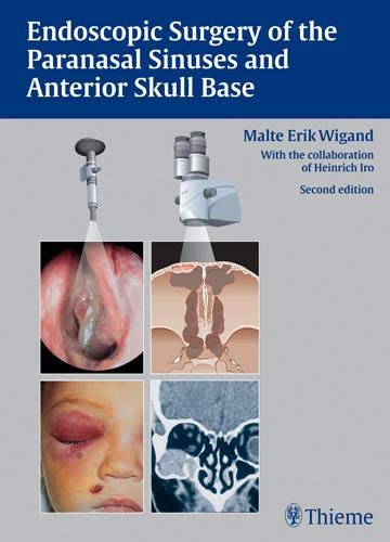 

surgical-sciences//endoscopic-surgery-of-the-paranasal-sinuses-and-anterior-skull-base-9783137494027