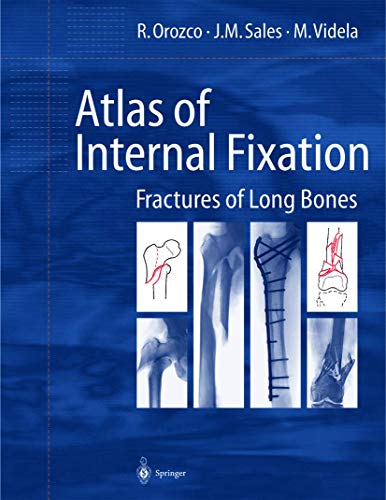 

surgical-sciences/orthopedics/atlas-of-internal-fixation-fractures-of-long-bones-9783540656210
