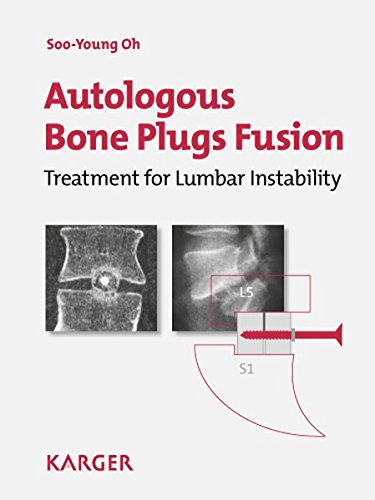 

surgical-sciences/orthopedics/autologous-bone-plugs-fusion-treatment-for-lumbar-instability-3e-criteria-technical-operative-notes-the-functioning-of-the-oh-s-screw-9783805591881
