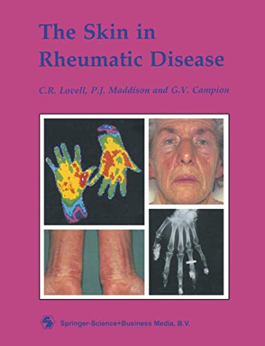 

special-offer/special-offer/the-skin-in-rheumatic-disease--9780412290008