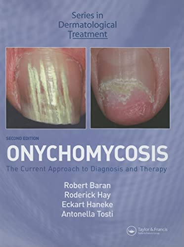 

special-offer/special-offer/onychomycosis-the-current-approach-to-diagnosis-and-therapy-series-in-de--9780415385794