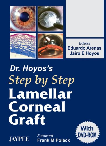 

best-sellers/jaypee-brothers-medical-publishers/dr-hoyos-step-by-step-lamellar-corneal-graft-with-dvd-rom-9788180617768