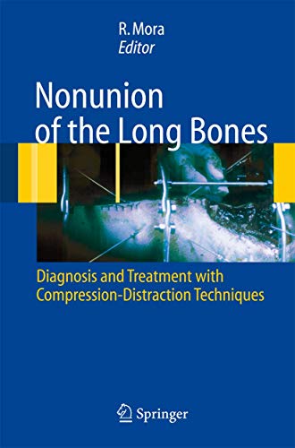 

mbbs/4-year/nonunion-of-the-long-bones-diagnosis-and-treatment-with-compression-distraction-techniques-9788847004085