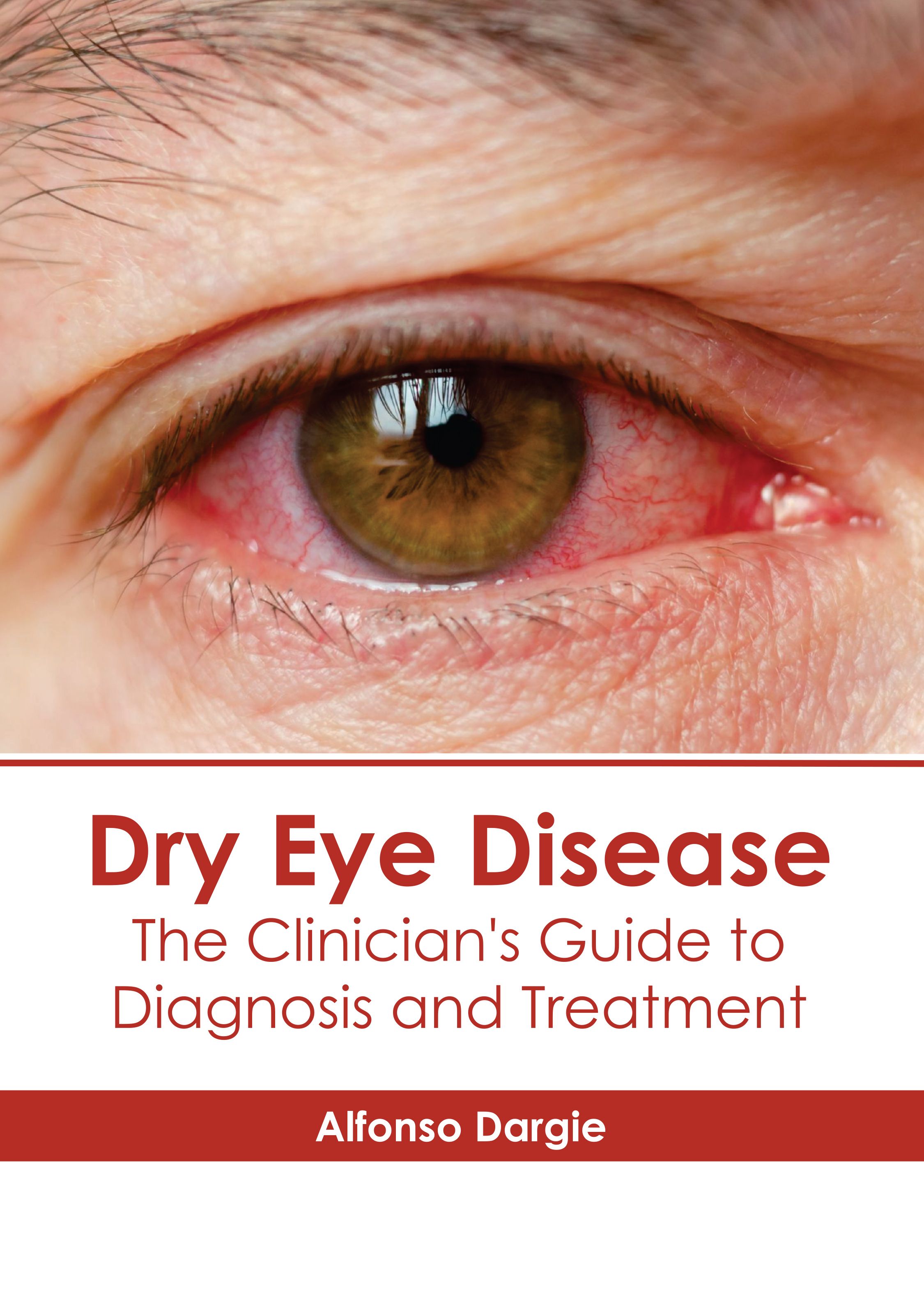 

medical-reference-books/ophthalmology/dry-eye-disease-the-clinician-s-guide-to-diagnosis-and-treatment-9798887400792