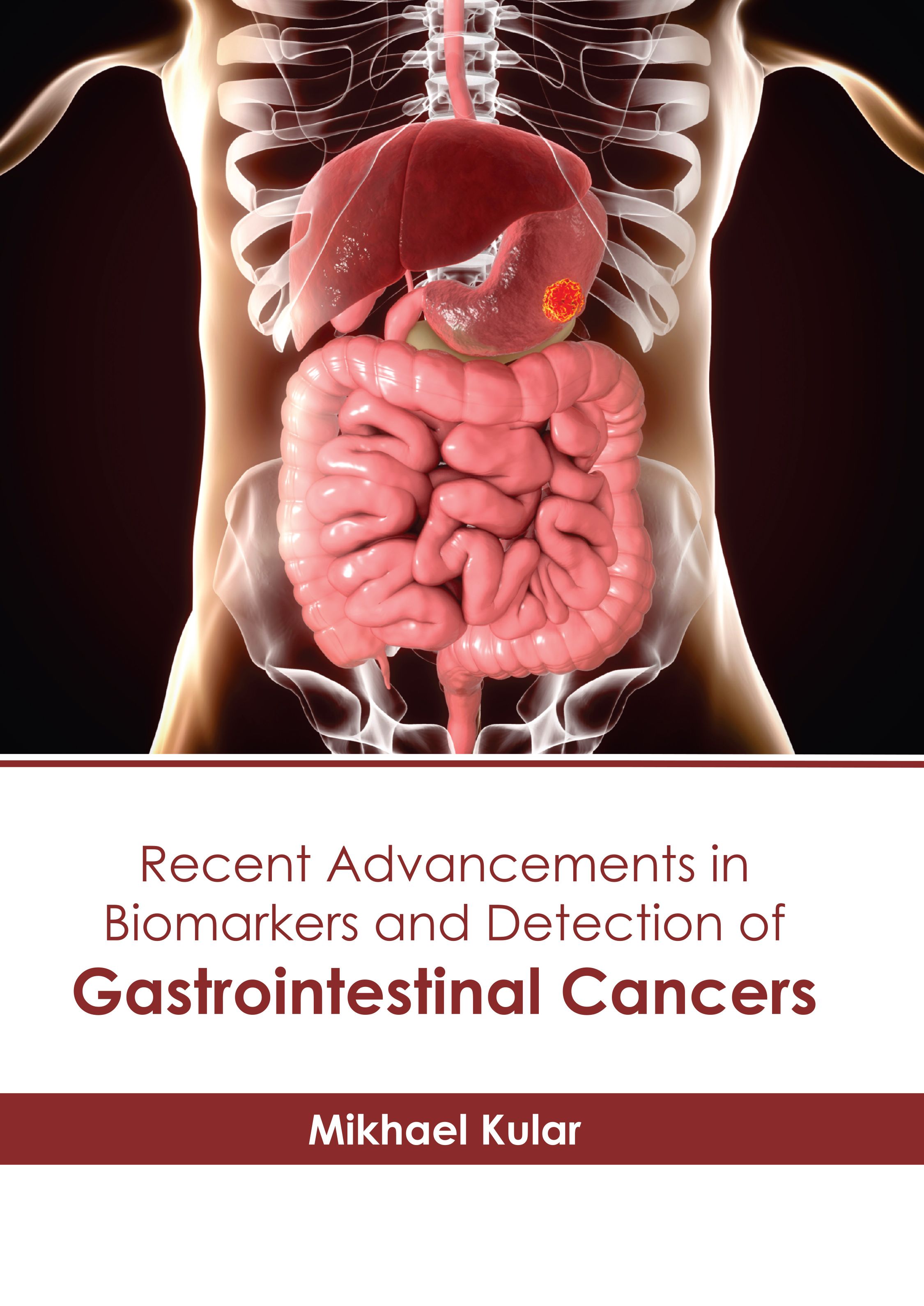 

exclusive-publishers/american-medical-publishers/recent-advancements-in-biomarkers-and-detection-of-gastrointestinal-cancers-9798887404196
