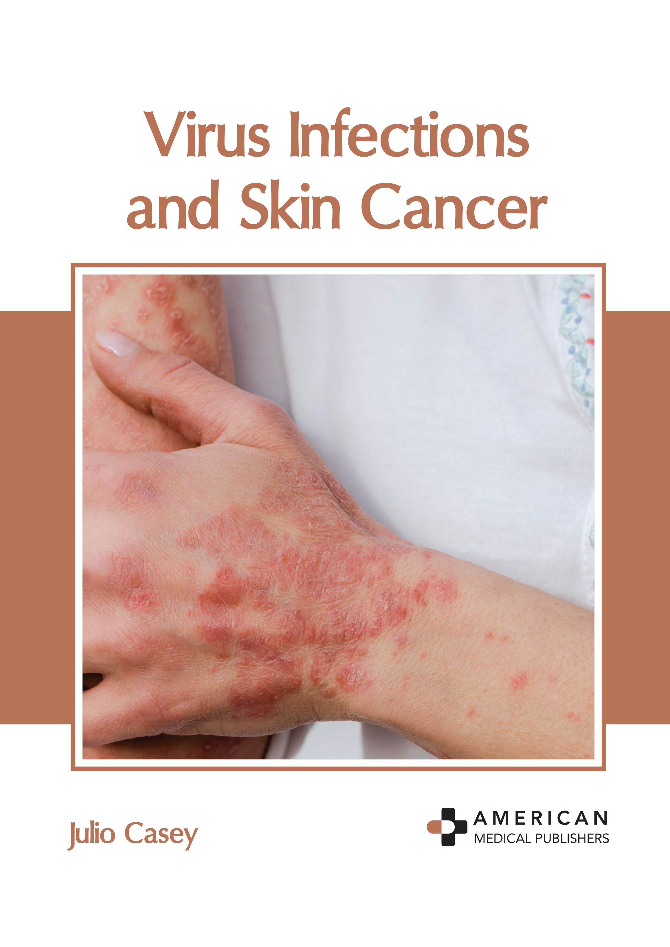 

exclusive-publishers/american-medical-publishers/virus-infections-and-skin-cancer-9798887405599