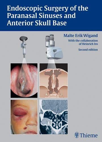 

exclusive-publishers/thieme-medical-publishers/endoscopic-surgery-of-the-paranasal-sinuses-and-anterior-skull-base-9789380378534