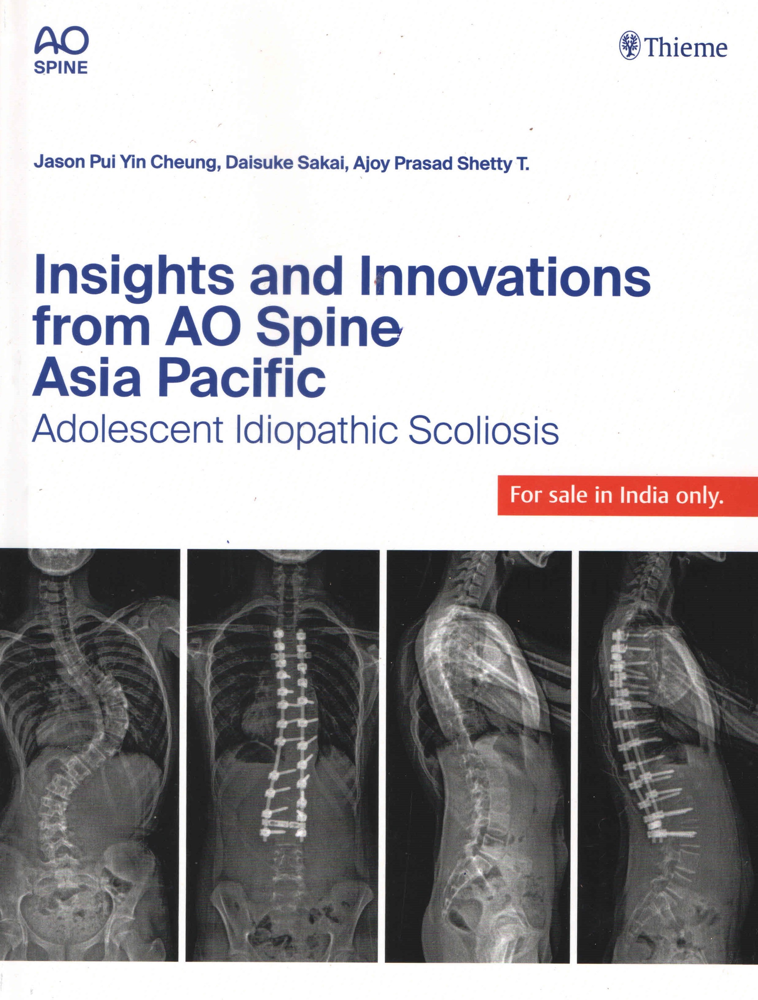 

exclusive-publishers/thieme-medical-publishers/insights-and-innovations-from-ao-spine-asia-pacific:-adolescent-idiopathic-scoliosis-9789395390620